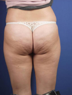 How I Got Rid Of Cellulite Home